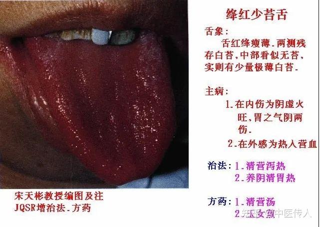 高清舌诊图解:各种临床证型舌象图谱大开眼界 - 知乎