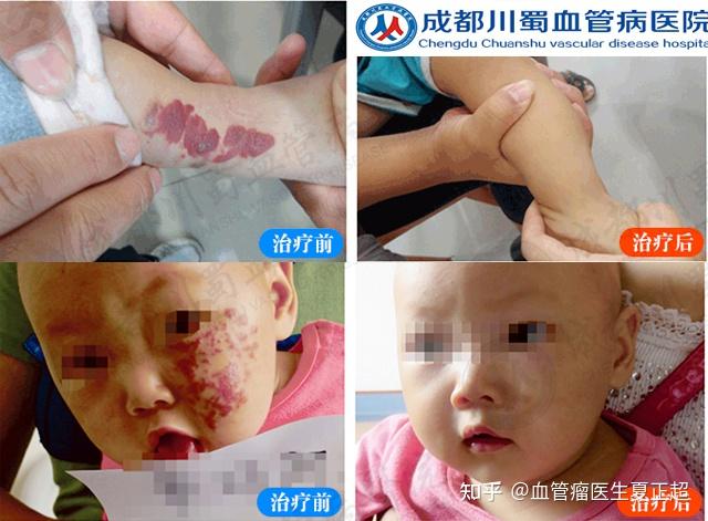 婴儿患有毛细血管瘤能治好吗? - 知乎