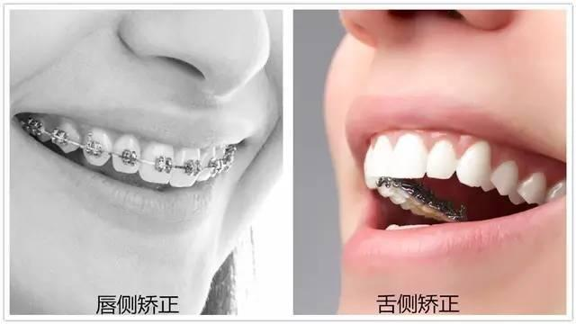 唇侧和舌侧矫正哪个快?牙齿矫正唇侧和舌侧区别有哪些 - 知乎