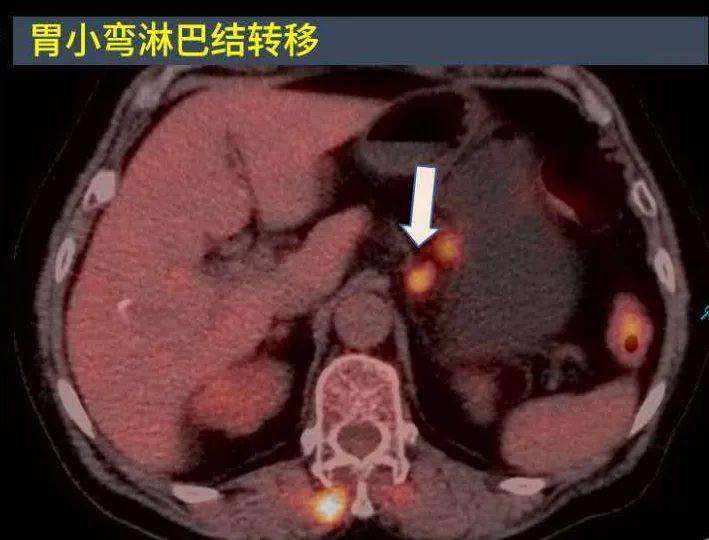 案例分享：PET/CT检查优势——快速寻找原发灶&准确确定病灶性质！ - 知乎