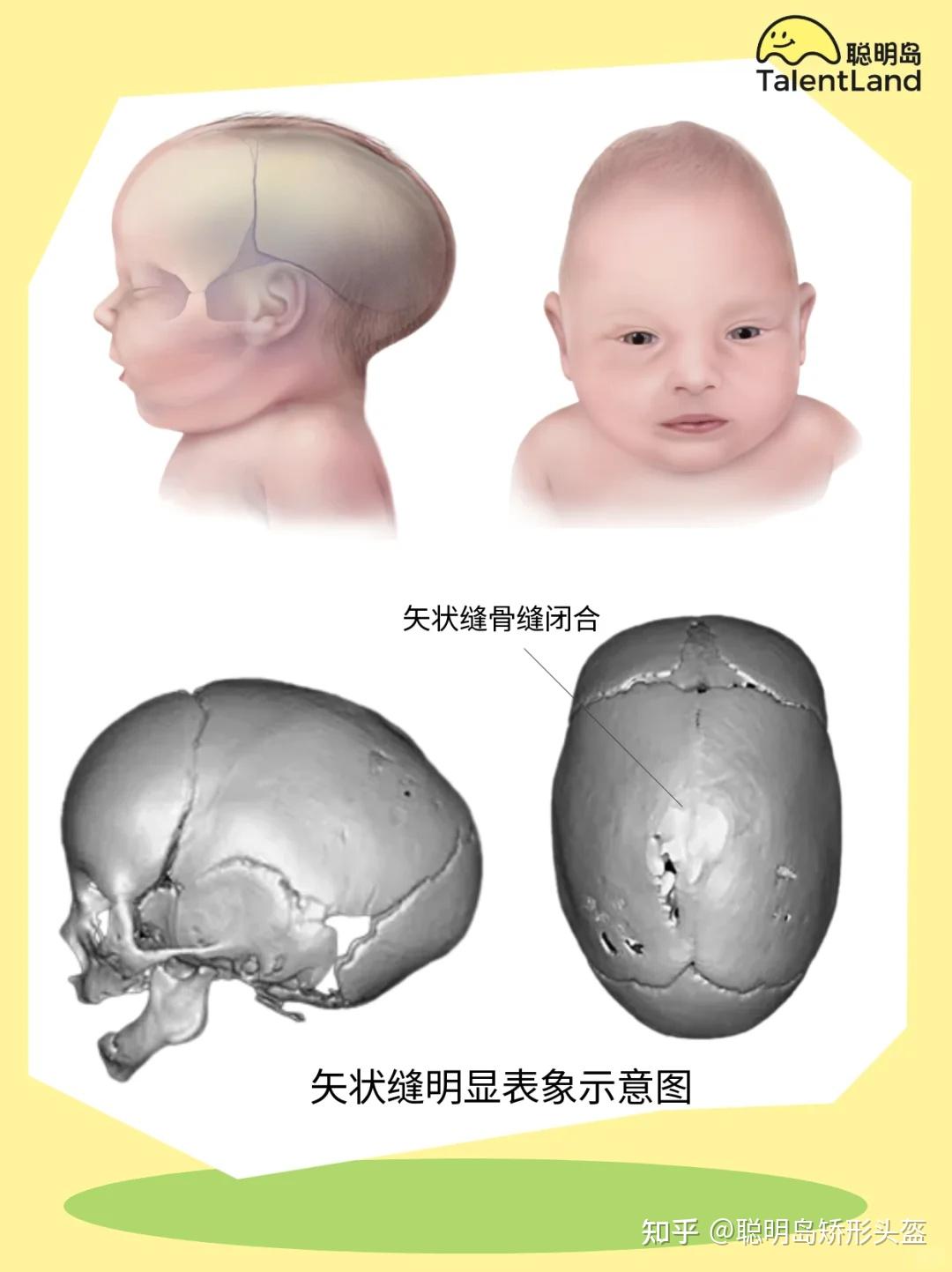 宝宝舟状头？家长们别慌！一文搞懂矢状缝早闭 - 知乎