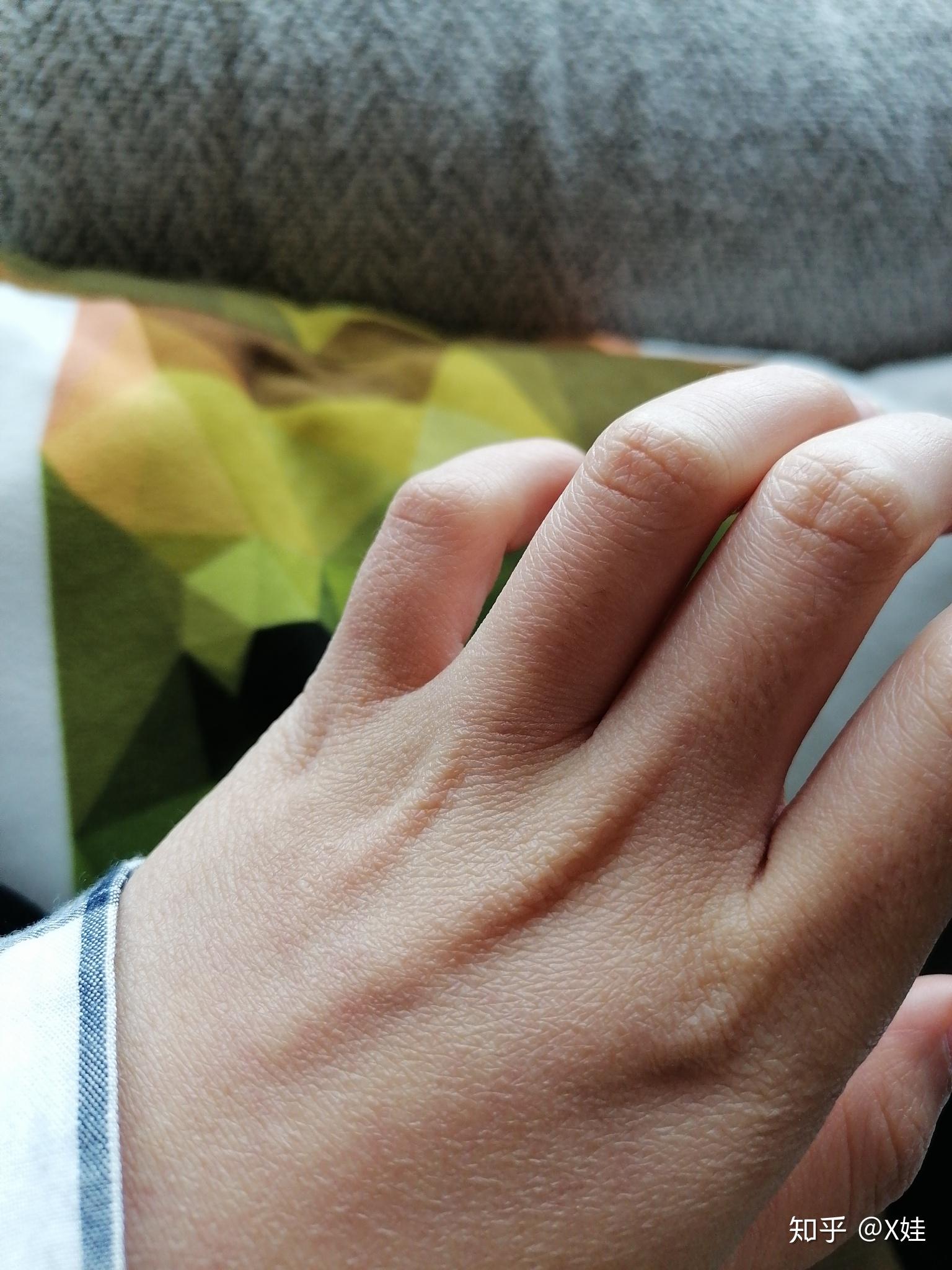 为什么手背皮肤有纹理如图细小的纹痕