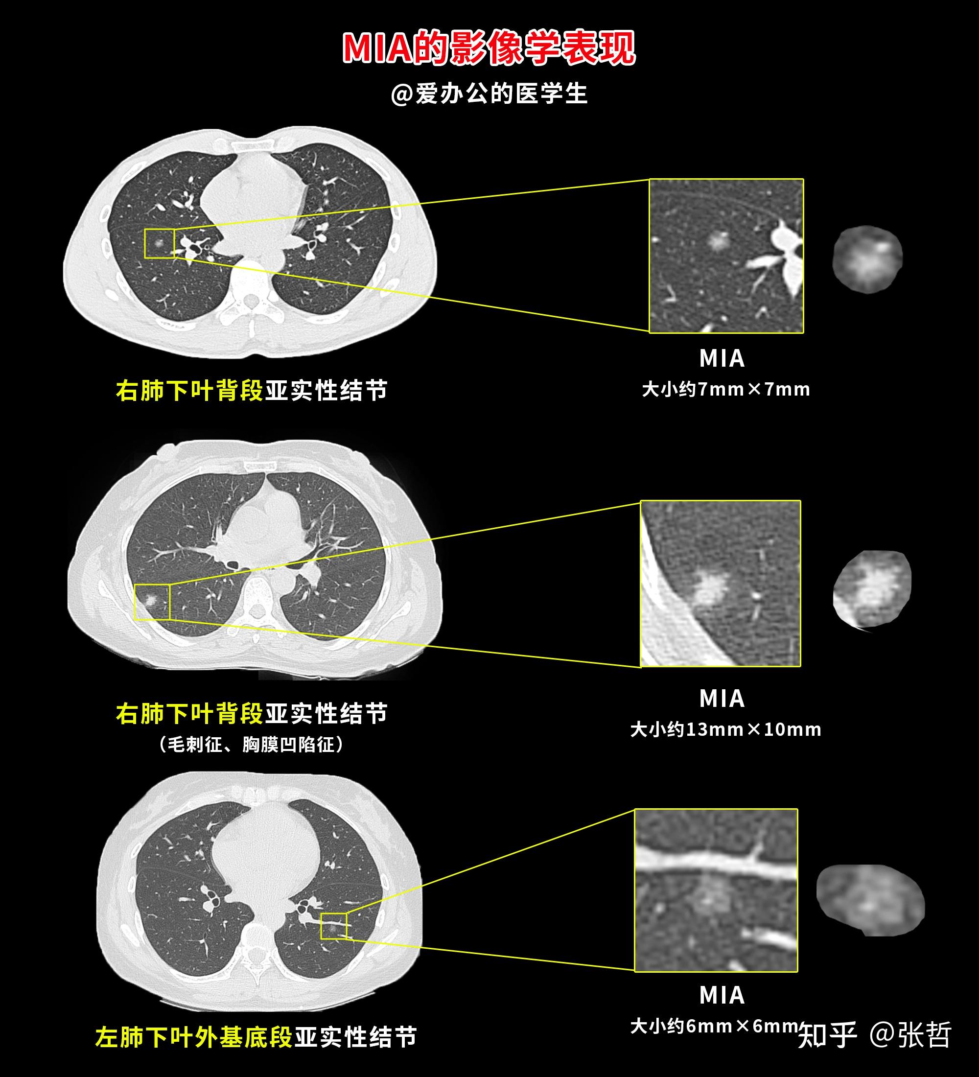 肺结节的影像学表现