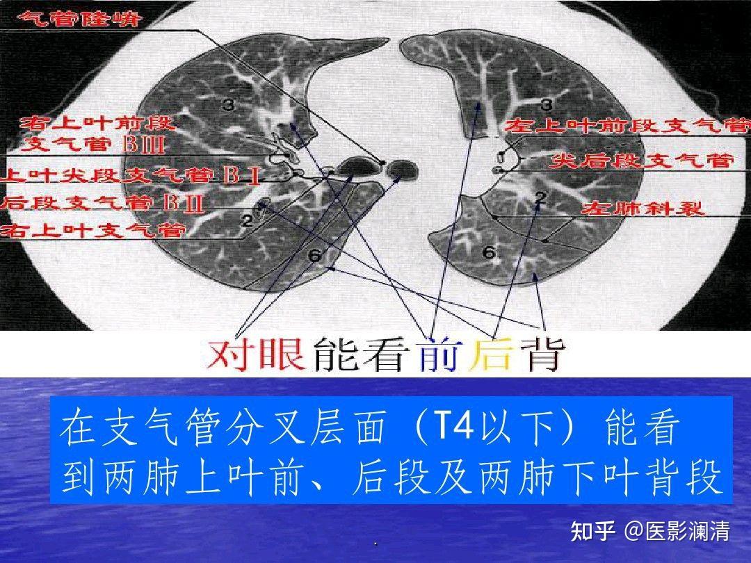 肺部五叶十八段在ct上怎么具体划分呢mimics做三维重建的话以什么标准