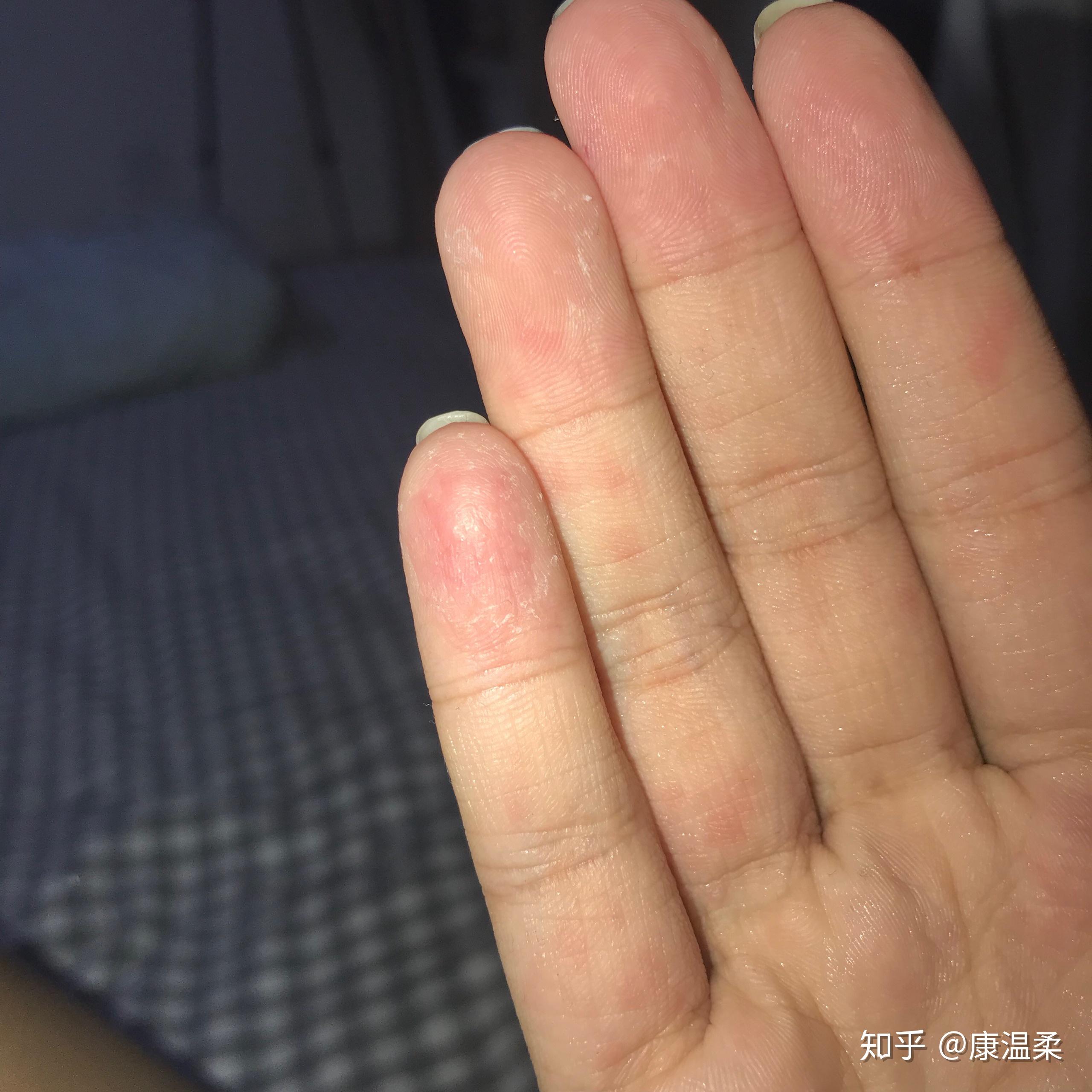 季節性手脫皮什麼原因有什麼方法可以根治嗎