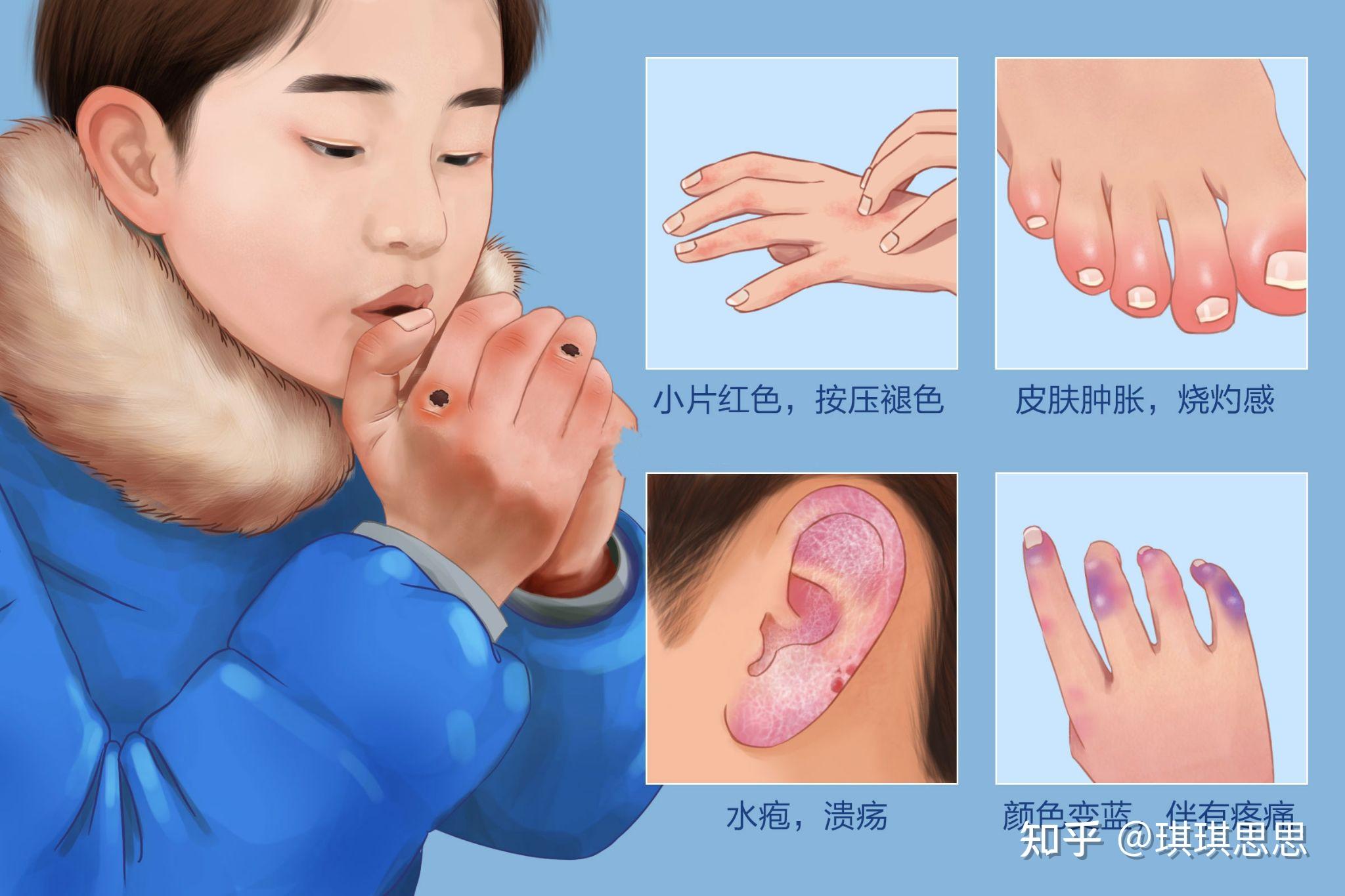 冻手之后手指变粗? - 知乎