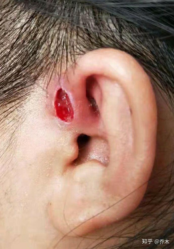 耳朵溃疡图片图片