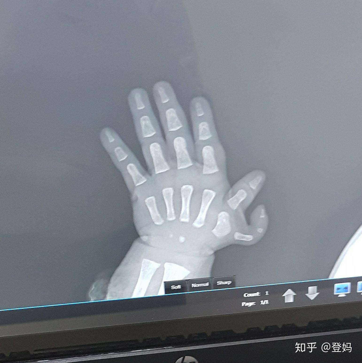 新生儿六指,多大月龄做手术合适?术后可以恢复到完全没有异常吗?