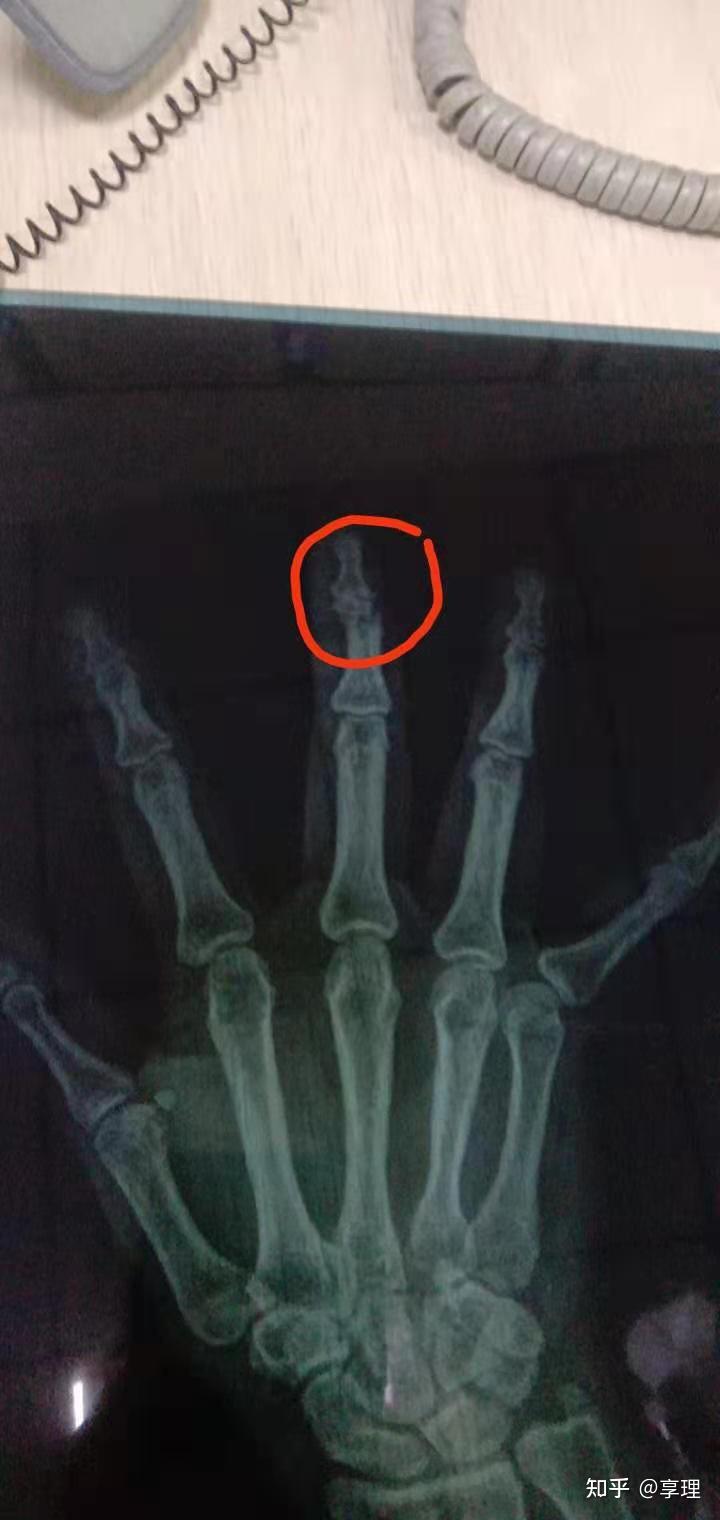 右手中指断了一节算几级伤残赔多少钱?