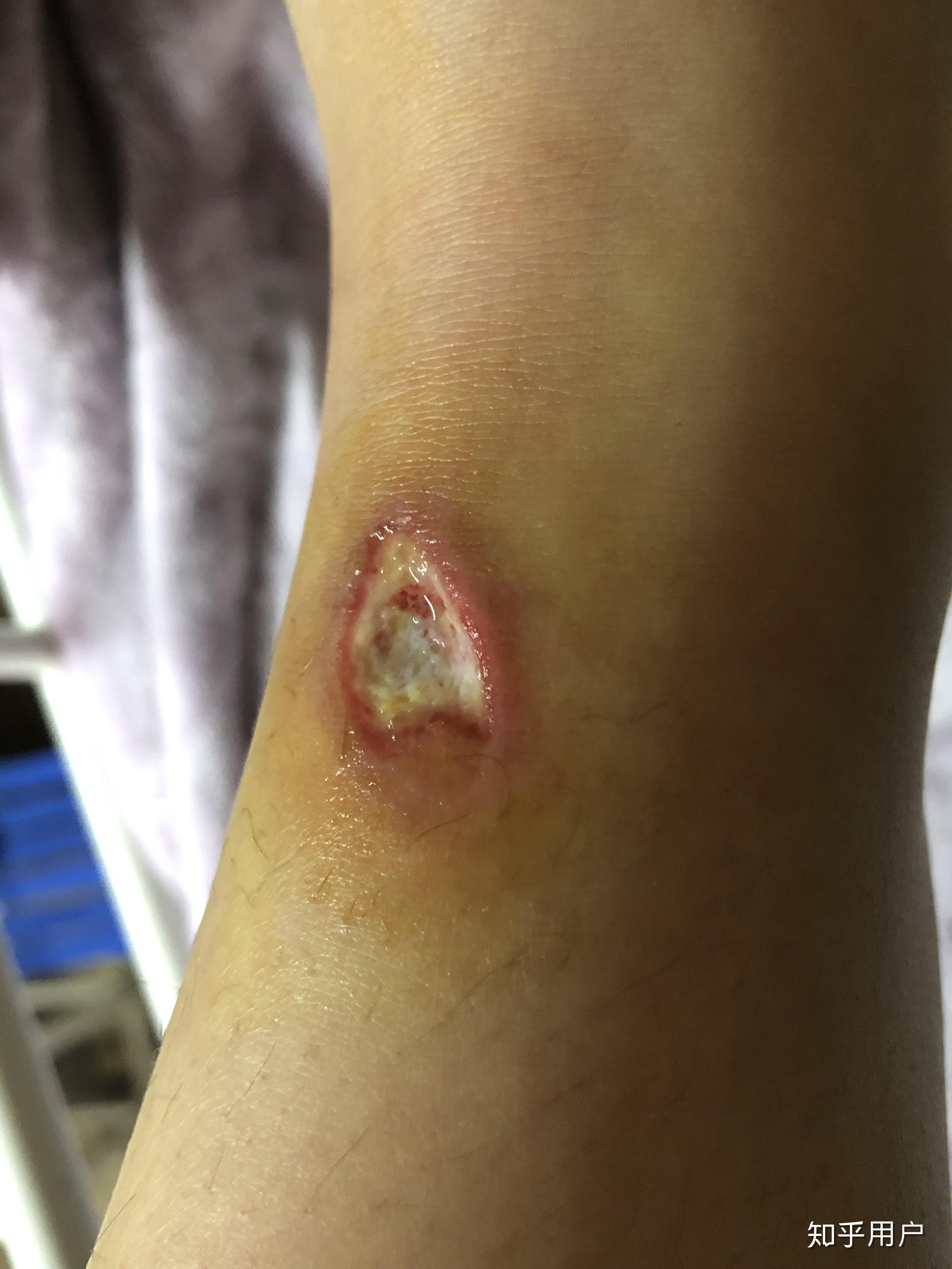 被毒蚊子咬了肿了很大一个包还很硬之后肿的包上面起了水泡挑破之后第