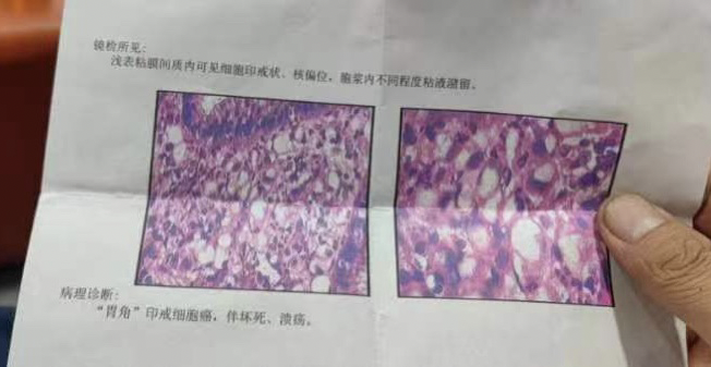 关于胃部印戒细胞癌~胃癌的用药笔记 - 知乎