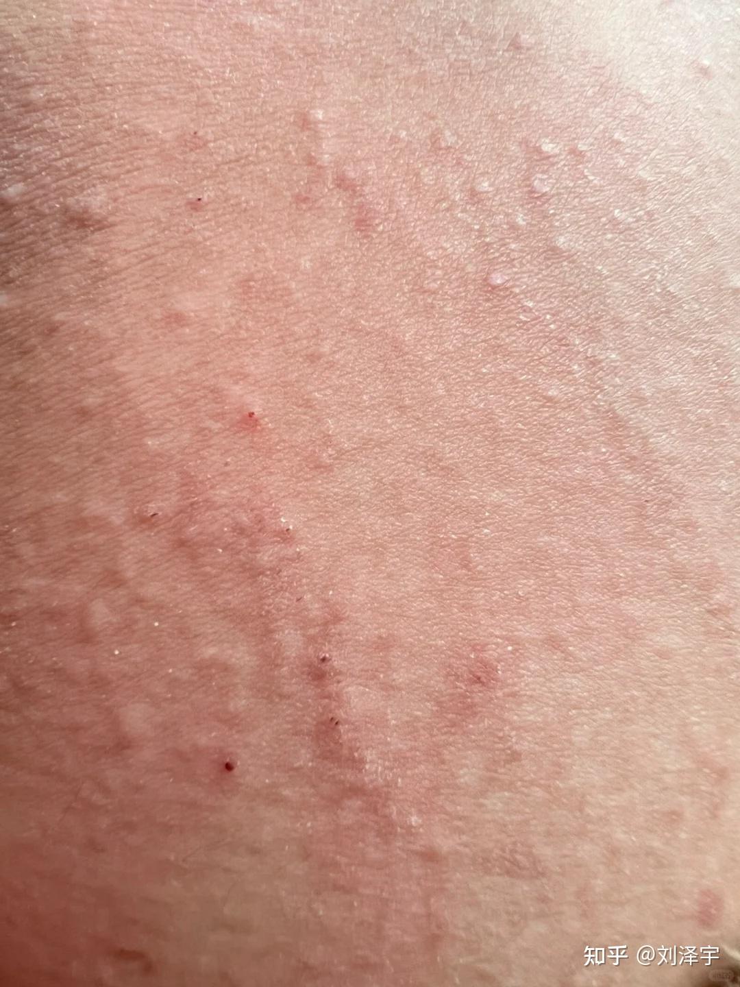 男生私密处和大腿根起一些红色的疹子还很痒是怎么回事? - 知乎