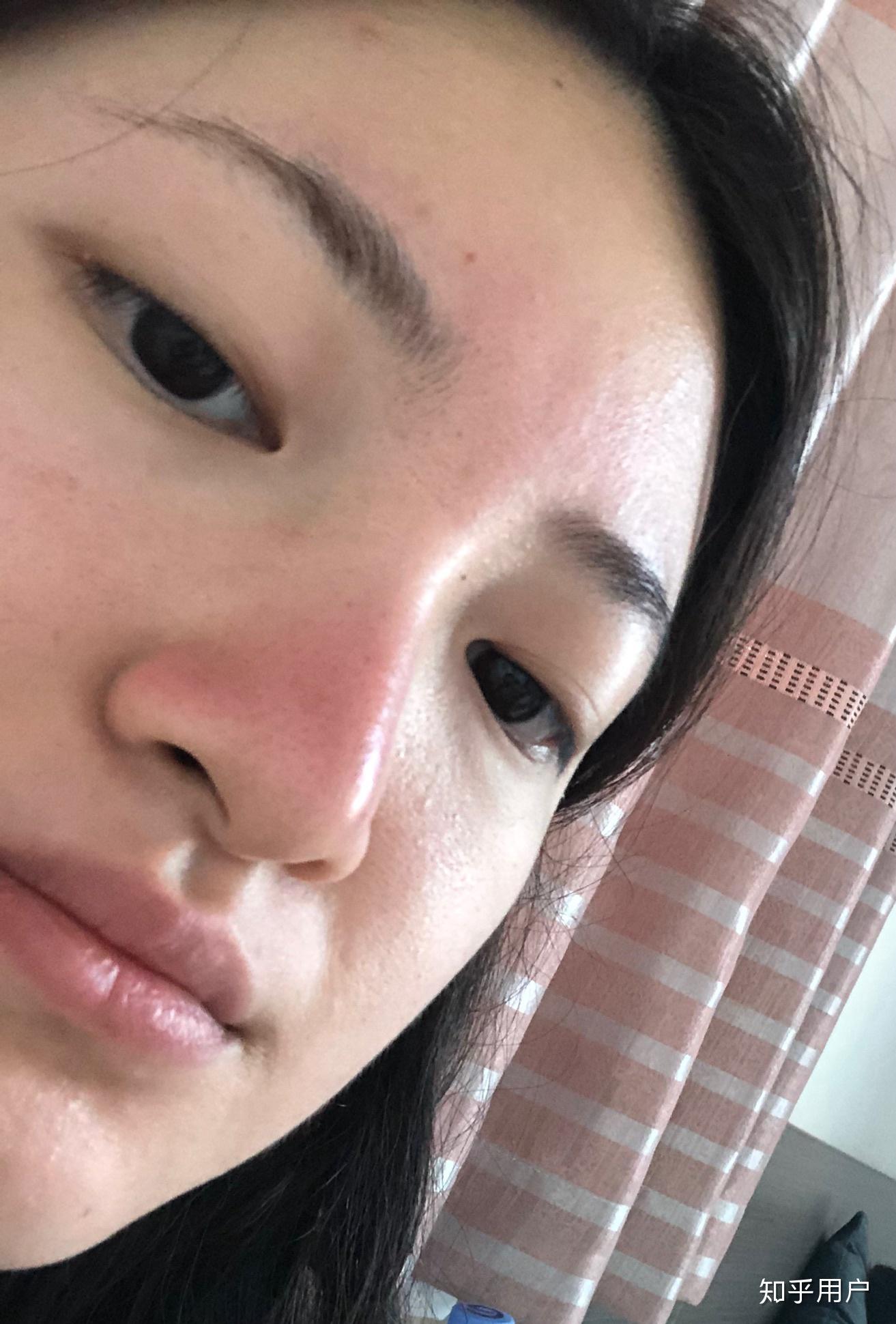 脸晒伤啥样? - 知乎