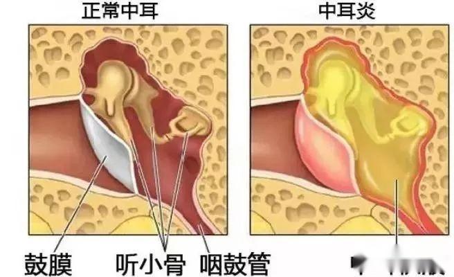 小孩为什么总是半夜耳朵疼,原来是“分泌性中耳炎”! - 知乎