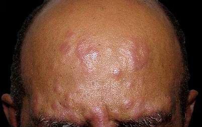 麻风病的治疗方法介绍