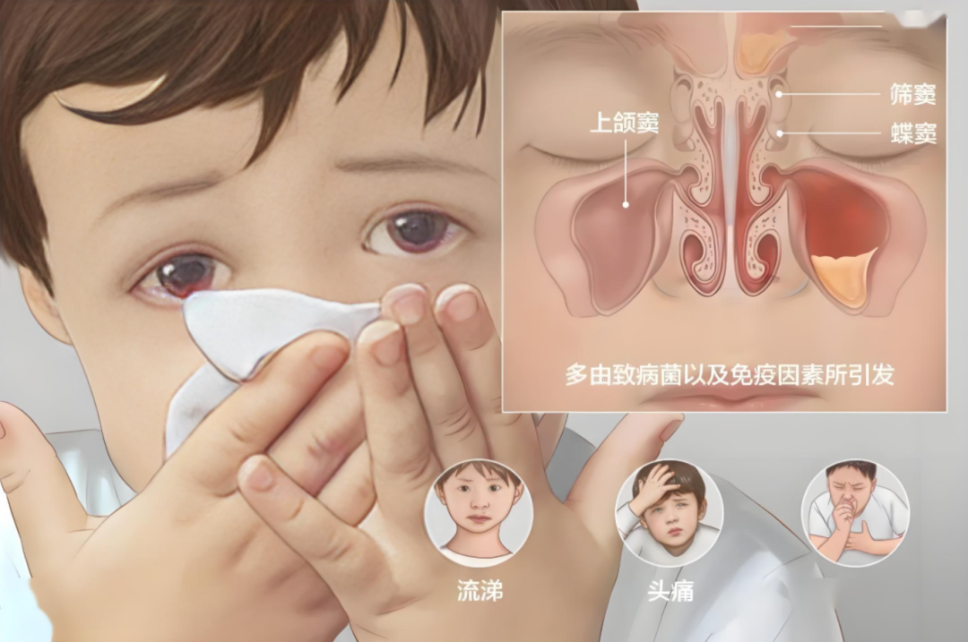 鼻窦炎头痛难忍？揭秘四种类型的鼻窦炎位置和特点 - 知乎