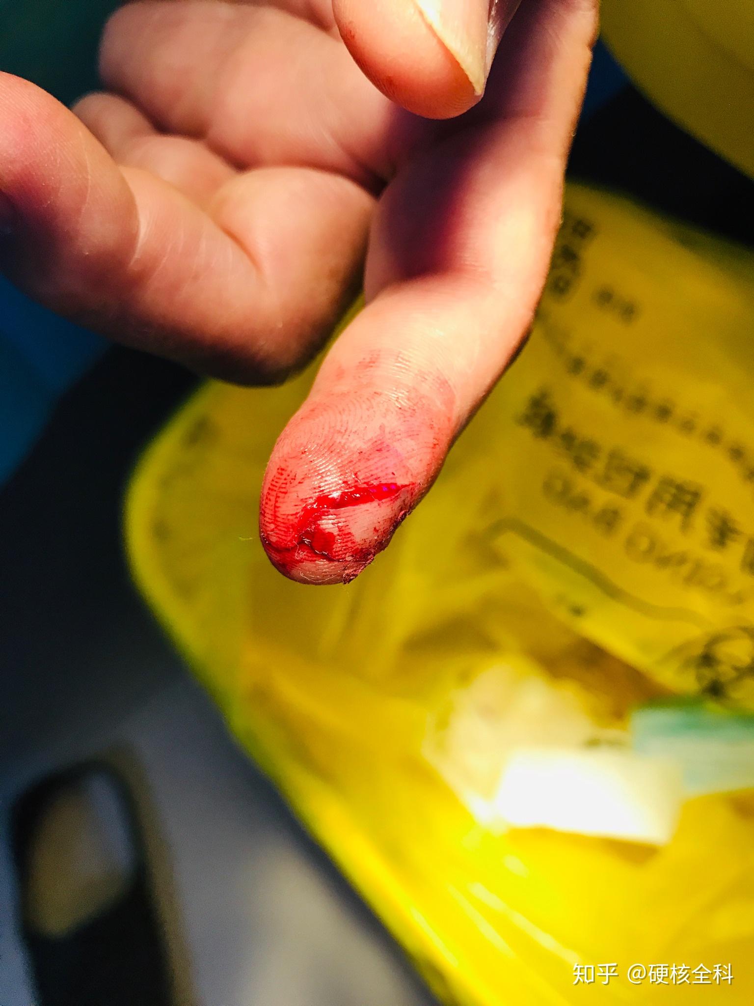 你有什么在手术过程中的切开组织图?