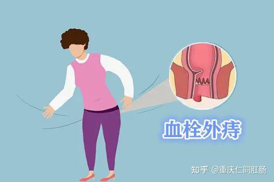 重庆肛肠手术医院?得了血栓痔怎样治疗? - 知乎