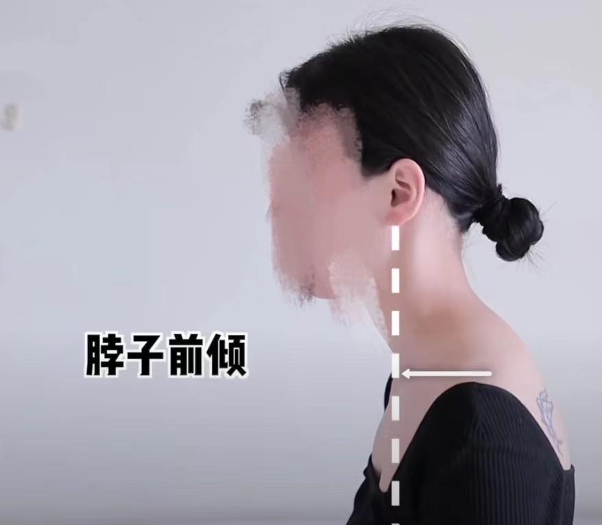 脖子前倾怎么矫正