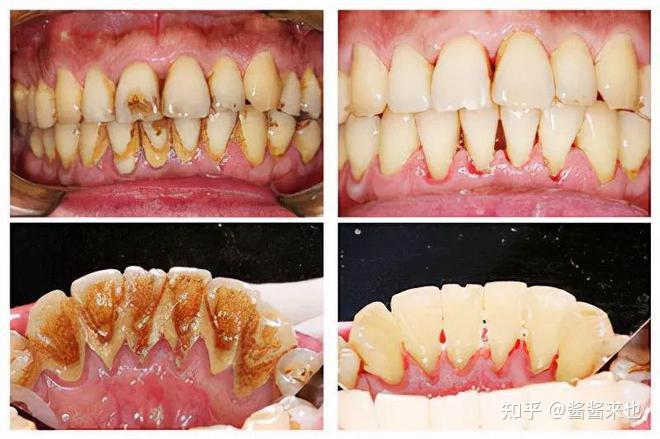 牙周炎到底要不要用衝牙器(水牙線)?