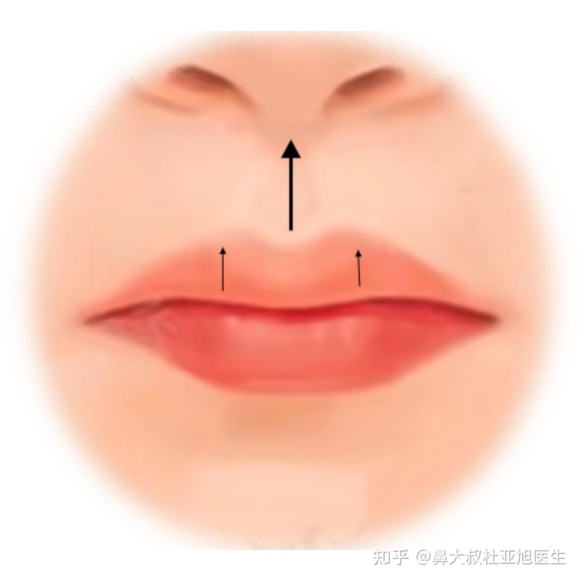 人中缩短和上唇改薄可以同时实现吗? - 知乎