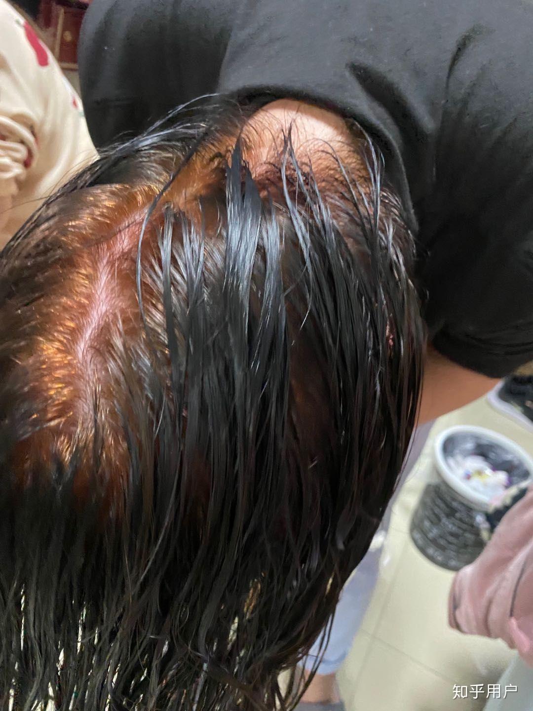 用泡沫染发剂爆顶了怎么补救