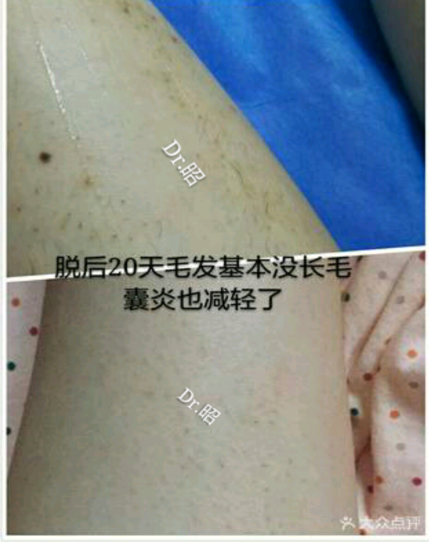 男人有必要做脱毛吗