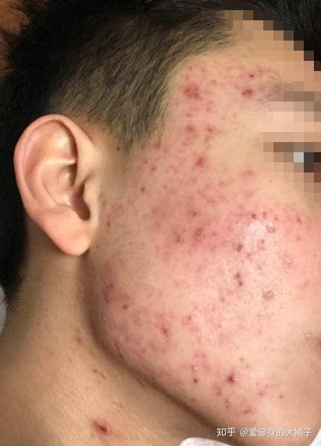 皮肤好不长痘是个什么感觉