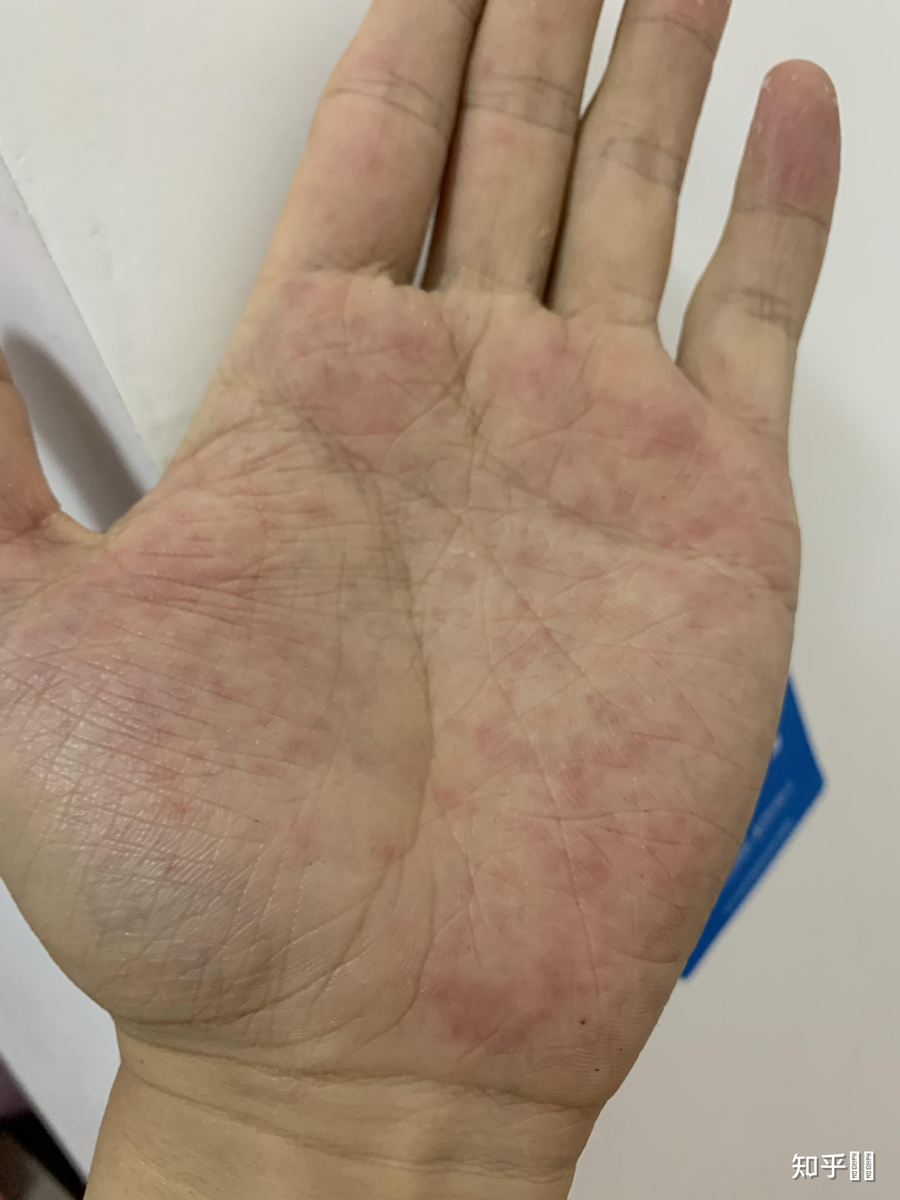 一到春秋两季,双手手心就会出现红点,很疼,略痒.