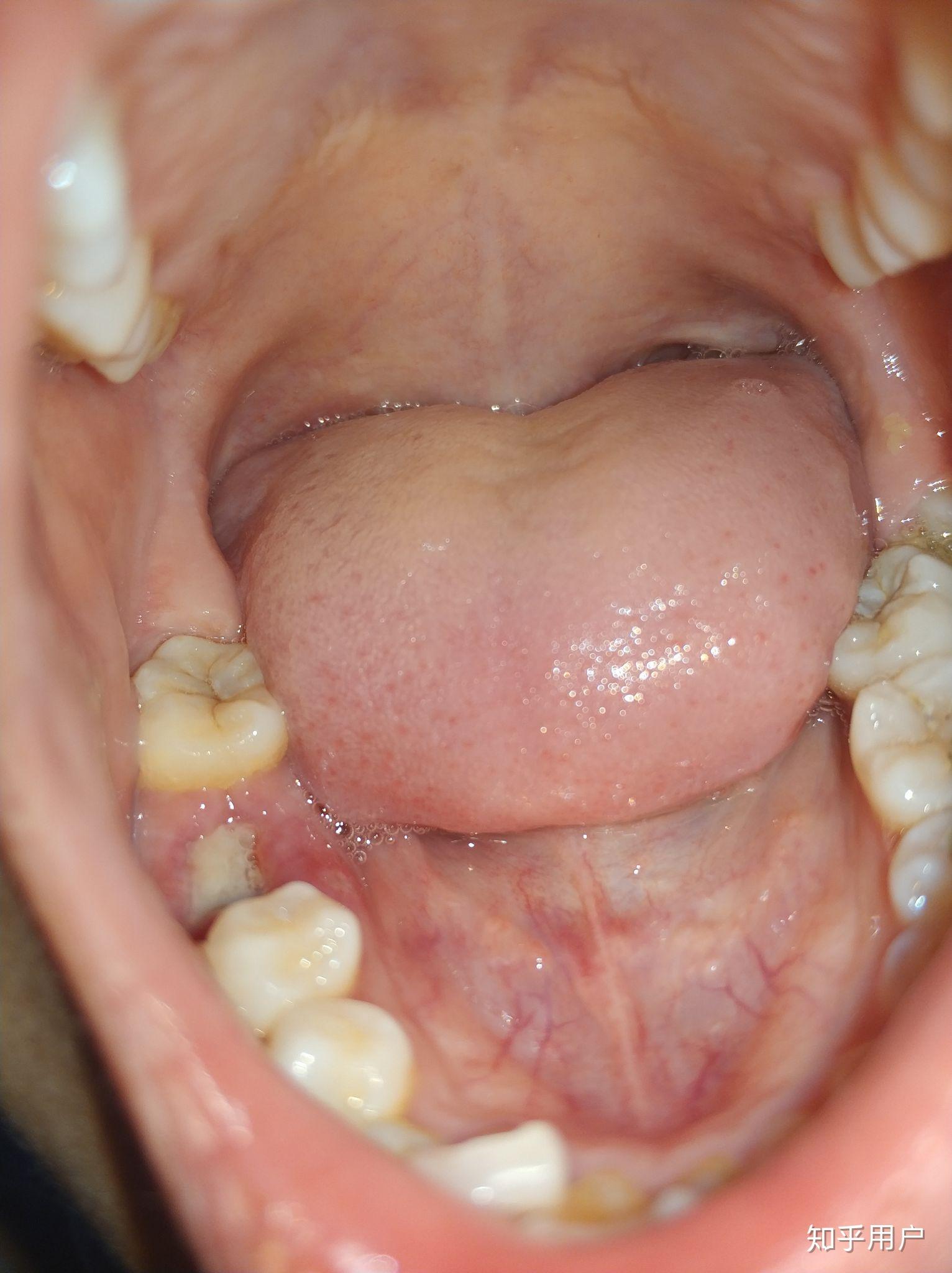 拔牙30天后牙窝状态图图片
