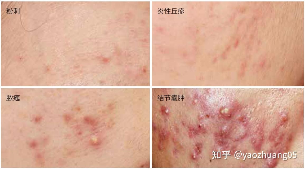 这是丘疹痘痘吗?如何治疗呀? - 知乎