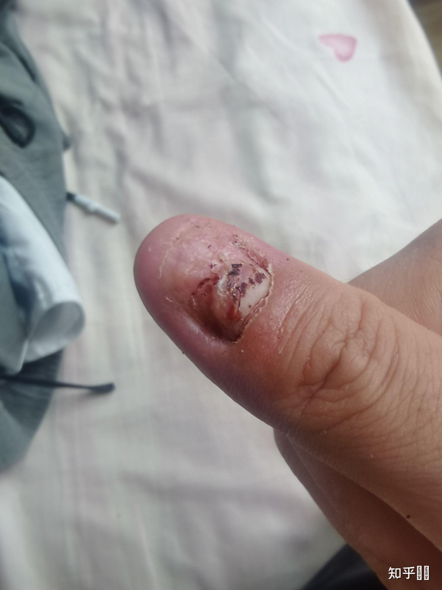 指甲被车门挤伤 指尖全是淤血 怎么办? - 知乎