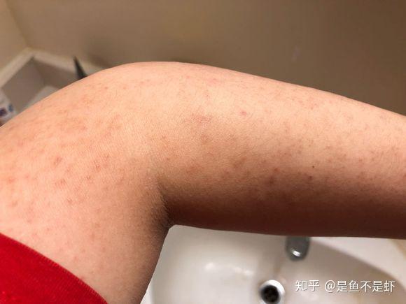 身上的鸡皮疙瘩如何清洗(身体上的鸡皮疙瘩怎么去除)