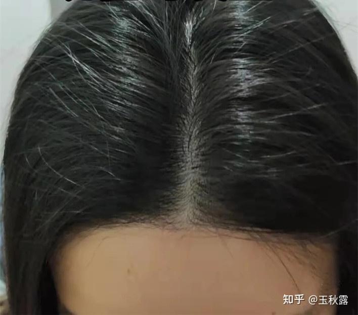 发旋处头发太少了!,我是不是要秃了,怎么办啊! - 知乎