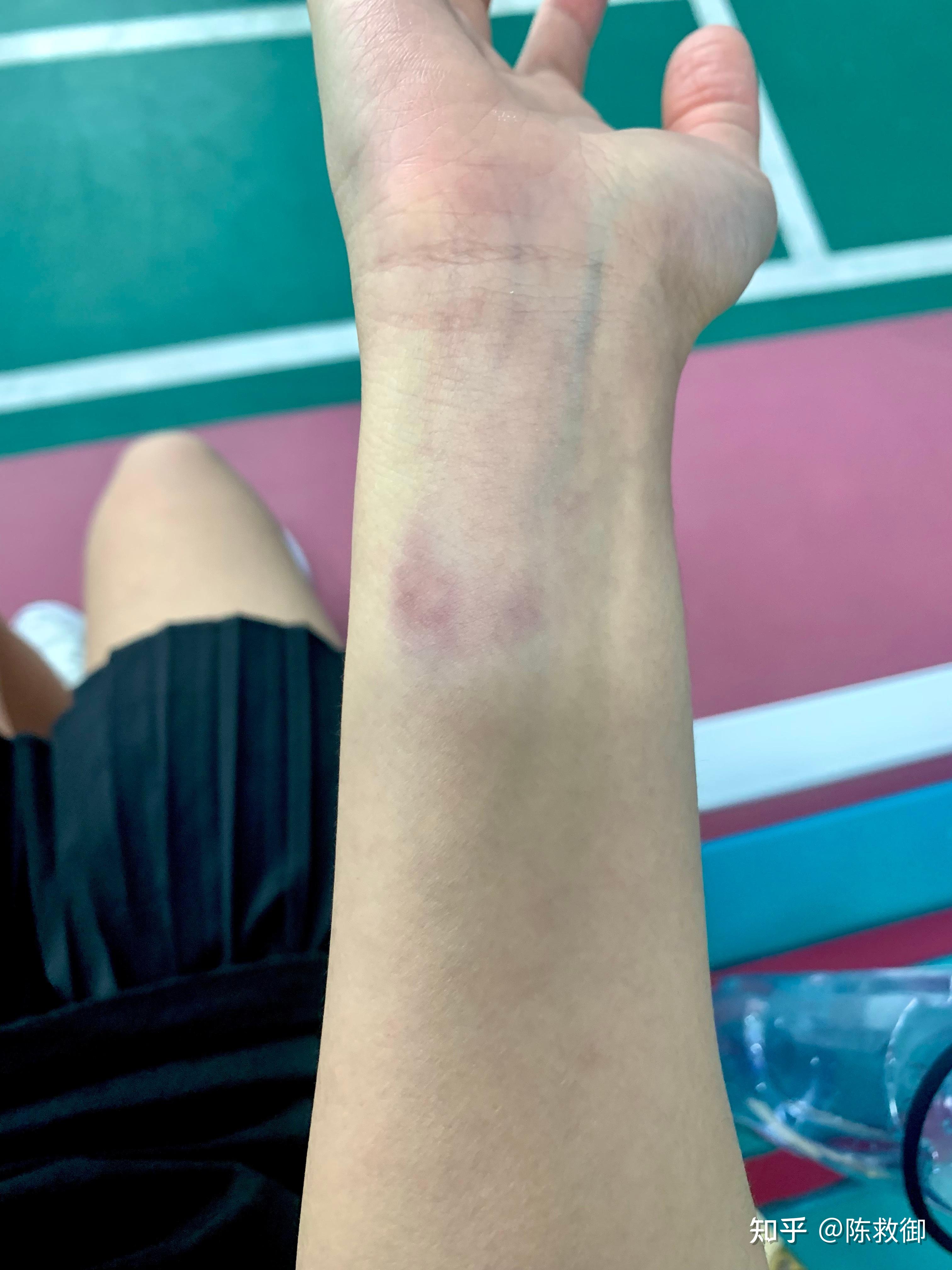 羽毛球求助帖 是不是发力有问题啊 手腕青了?