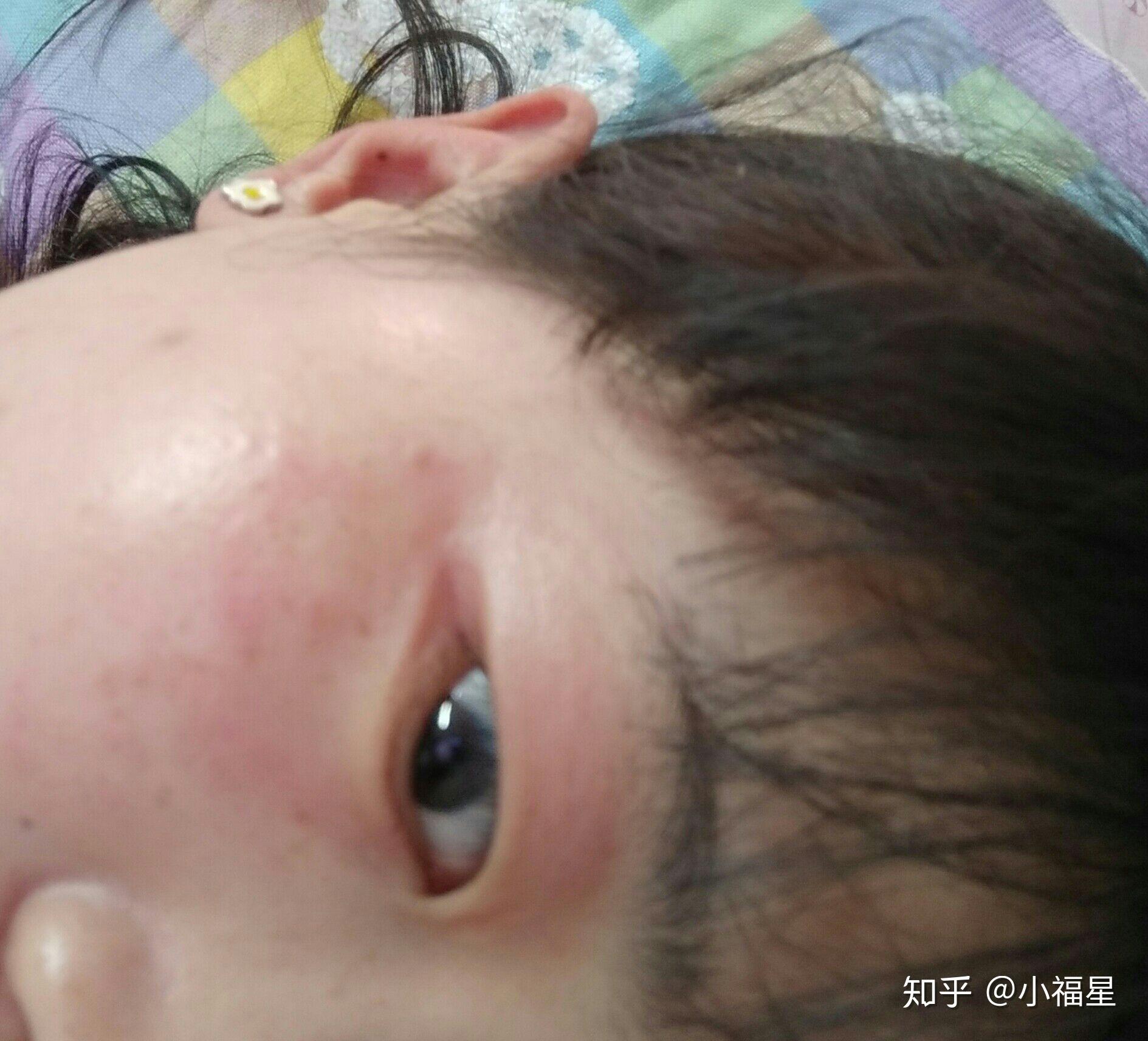 左眼皮干痒起皮还有点皱有时候会发红双眼皮像分不开的有荨麻疹症状