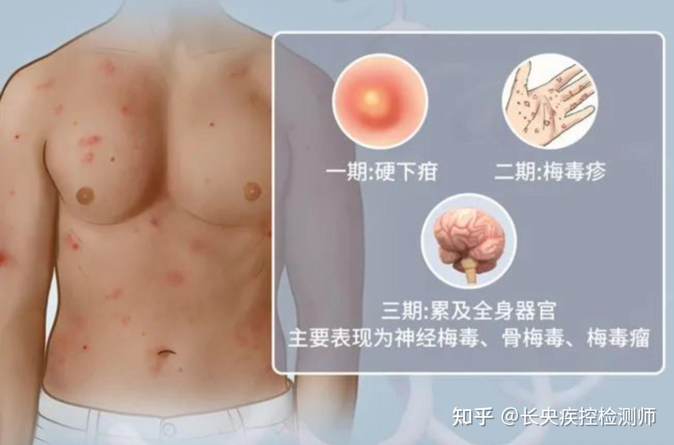 求问我这个是梅毒硬下疳吗