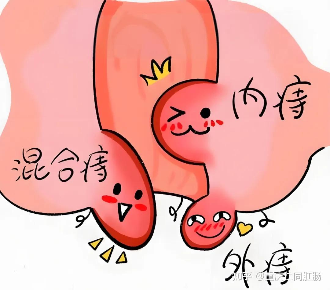 重庆那家医院的肛肠科好些有痔疮肉球不敢拉屎怎么办