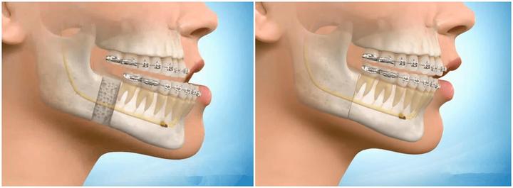 偏颌与反颌会不会越来越严重该不该做正颌手术