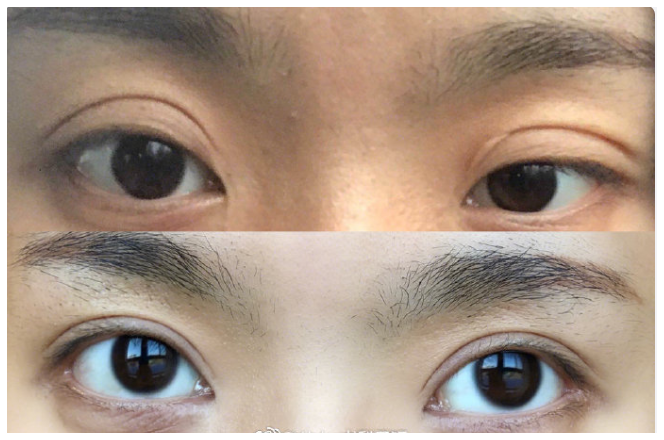 请问我这种突出眼大小眼的情况可以做双眼皮手术吗