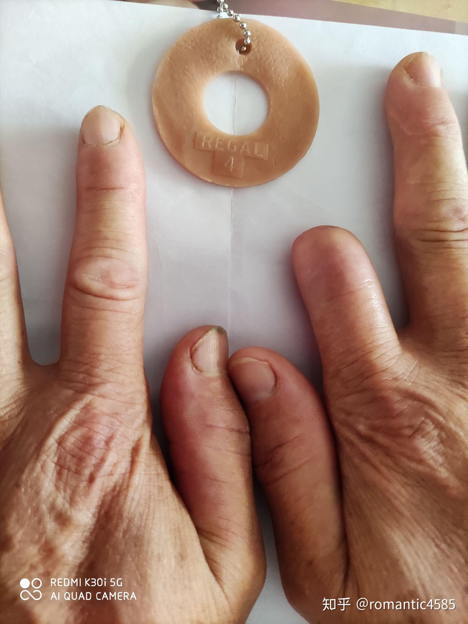 左手食指断了手术失败十级伤残可以要求单位接假肢吗