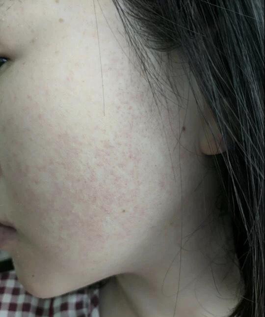 毛周角质发生在脸上如何改善