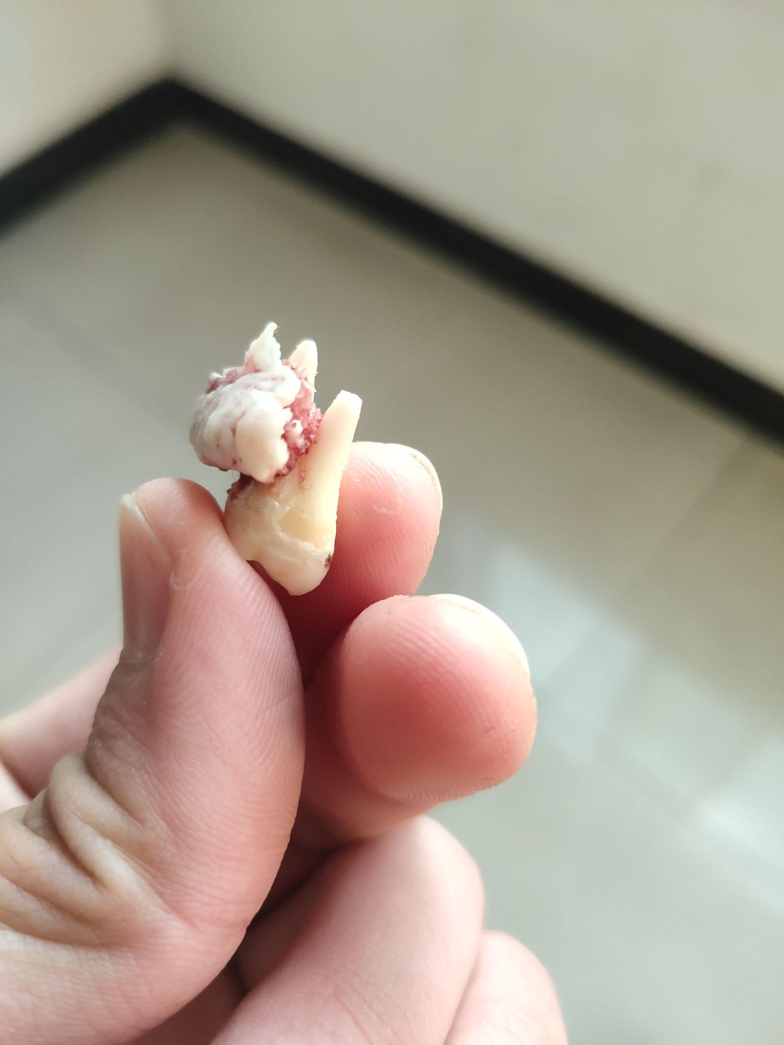 拔智齿拔出一块骨头正常吗