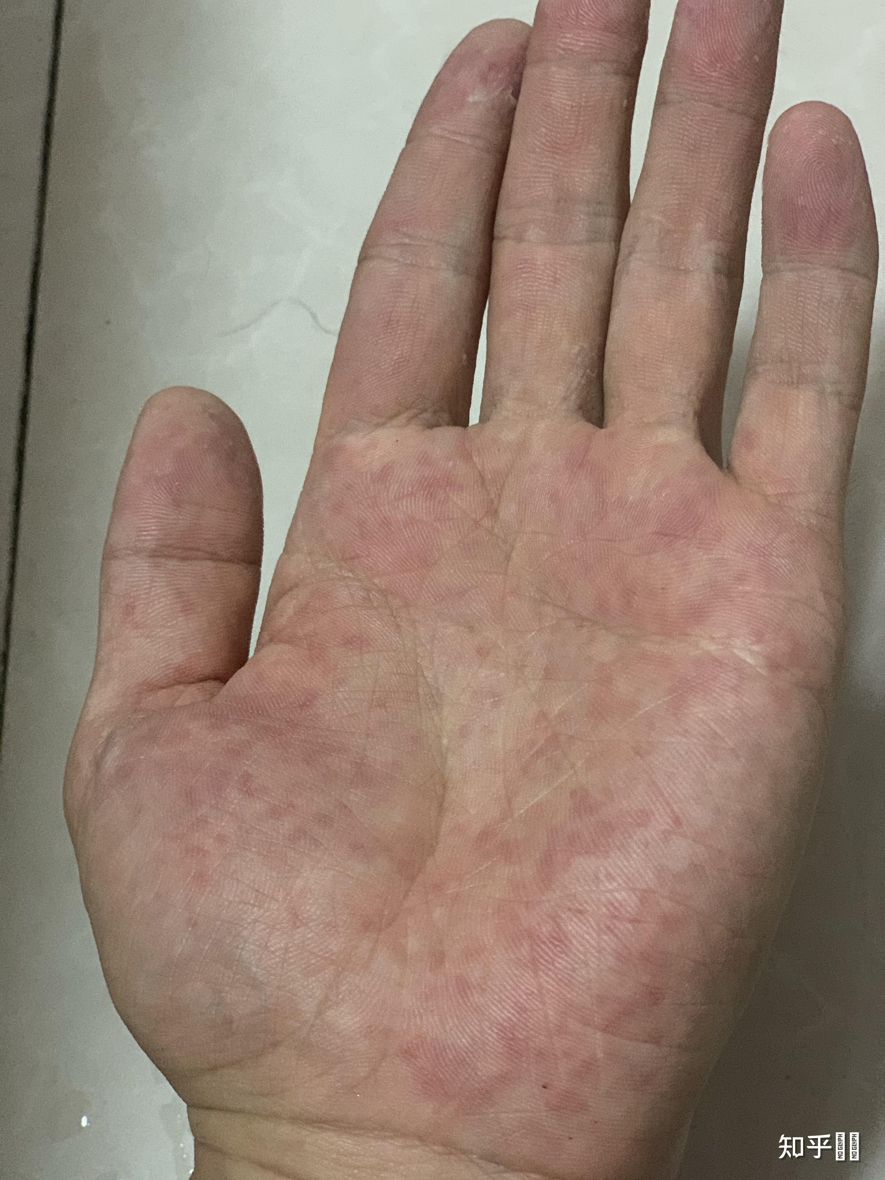 一到春秋两季,双手手心就会出现红点,很疼,略痒.