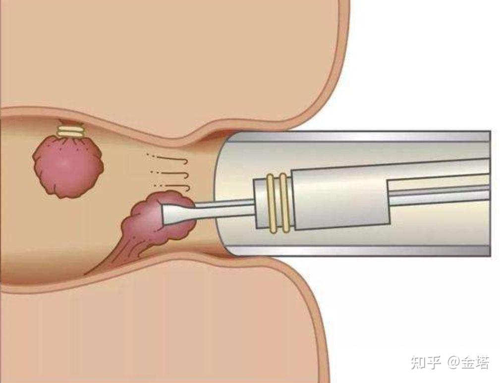 对于痔疮手术有网上说的那么可怕吗? - 知乎