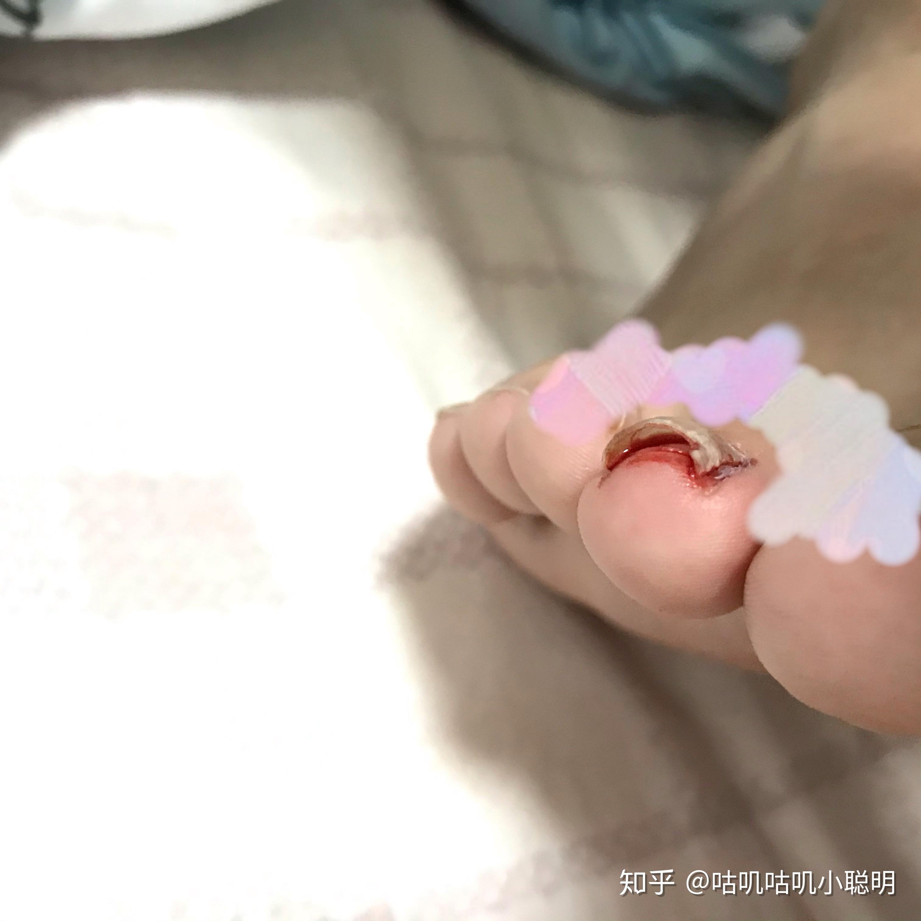 大脚趾甲盖整个掀起来了怎么办? - 知乎
