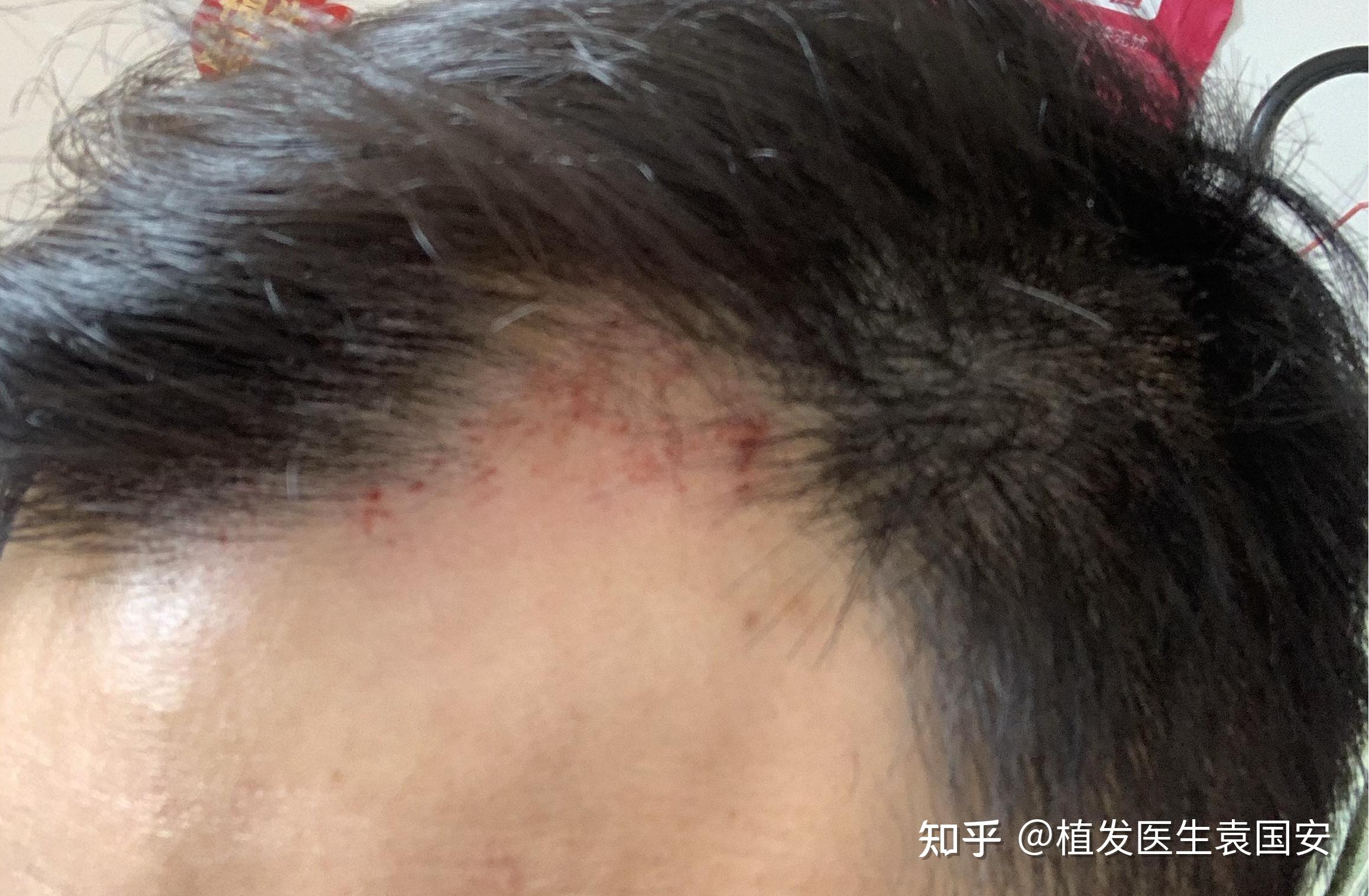 发缝宽的人如何自救? - 知乎