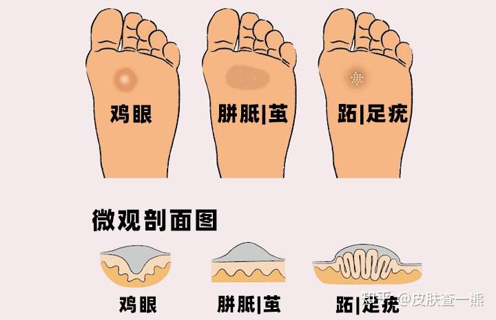 怎么分辨脚上长得是鸡眼还是疣? - 知乎
