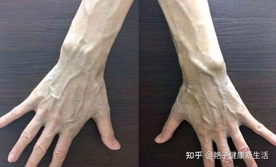 血管好不好,看手或许知道,多运动多喝水能改善血管动脉硬化吗? - 知乎