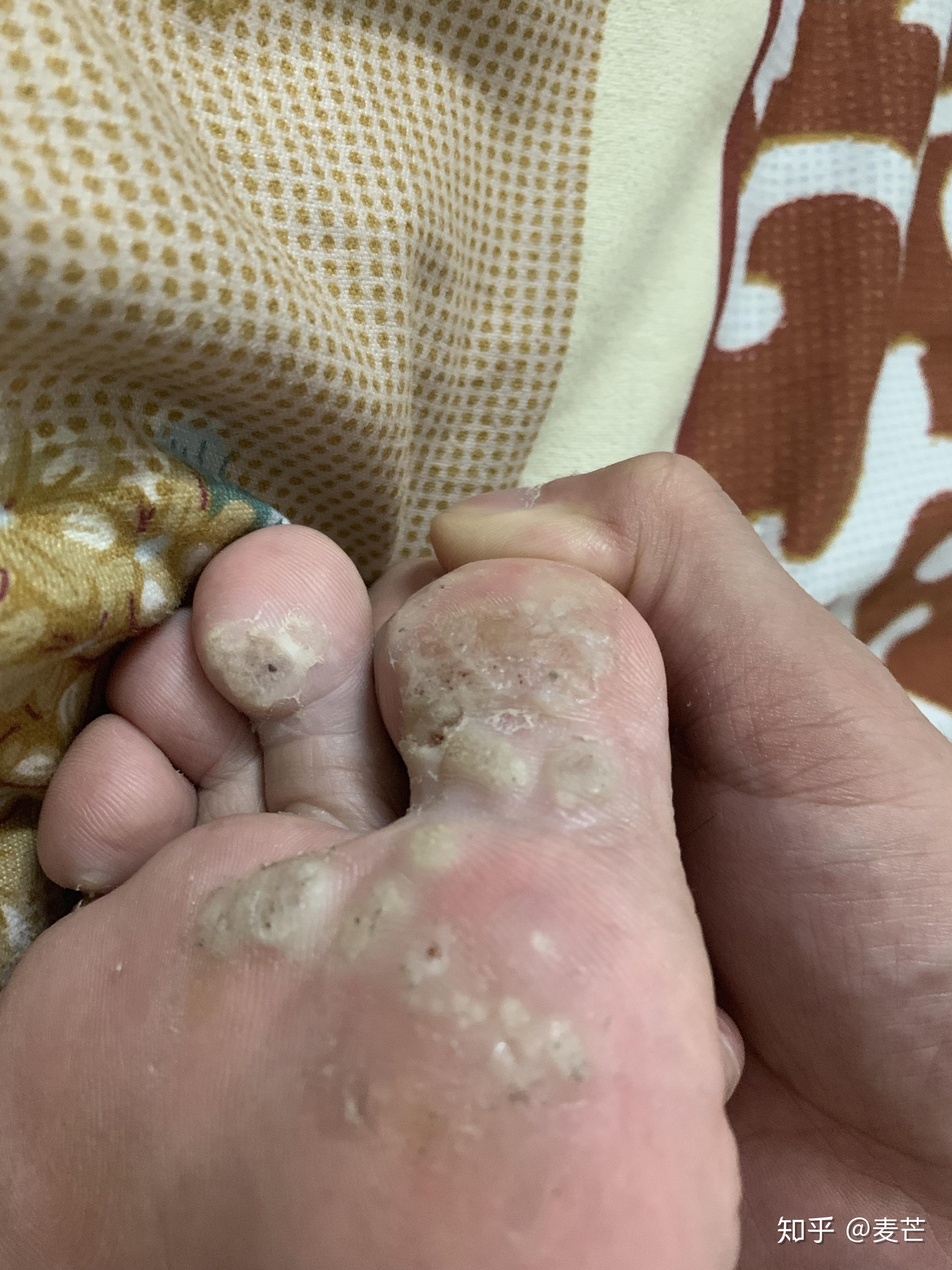 用激光治脚底的跖疣疼吗